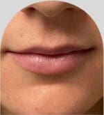 Lip Fillers - Case 25664 - Before