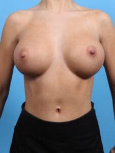 Breast Augmentation - Case 25706 - After