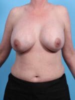 Breast Augmentation - Case 25756 - After
