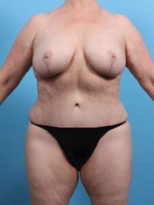 Breast Lift/Reduction w/o Implants - Case 25791 - After