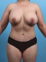 Breast Lift/Reduction with Implants - Case 25889 - After