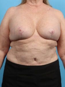 Breast Lift/Reduction with Implants - Case 25899 - After