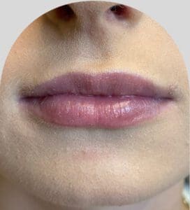 Lip Fillers - Case 25908 - After