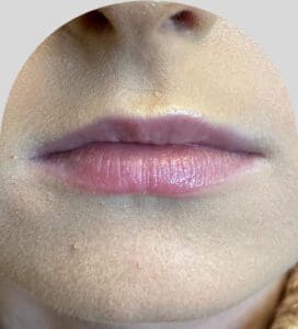 Lip Fillers - Case 25908 - Before