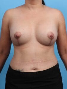 Breast Lift/Reduction with Implants - Case 26181 - After