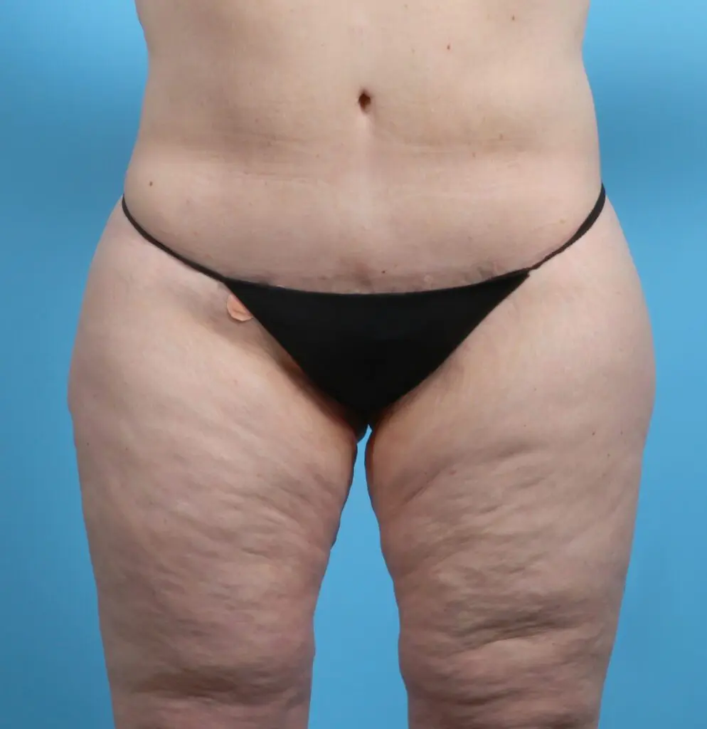After Weight Loss - Case 26229 - After