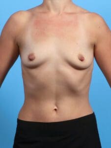 Breast Augmentation - Case 26236 - Before
