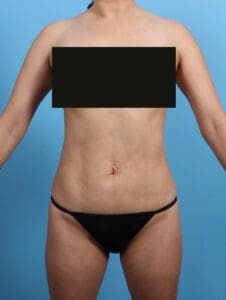 Liposuction - Case 26326 - After