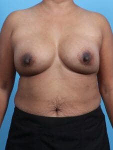 Breast Implant Revision - Case 26372 - After