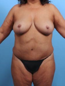 Breast Lift/Reduction w/o Implants - Case 26381 - After