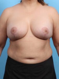 Breast Implant Revision - Case 26406 - After
