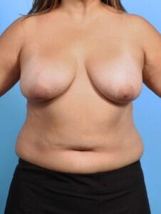 Breast Implant Revision - Case 26406 - Before