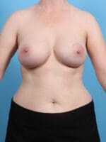 Breast Augmentation - Case 26446 - After