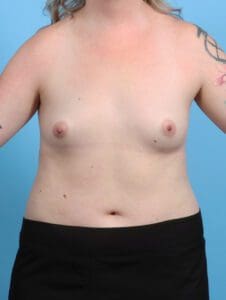 Breast Augmentation - Case 26478 - Before