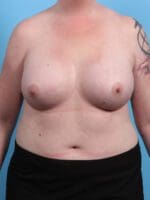 Breast Augmentation - Case 26478 - After