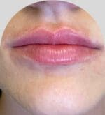 Lip Fillers - Case 26543 - After