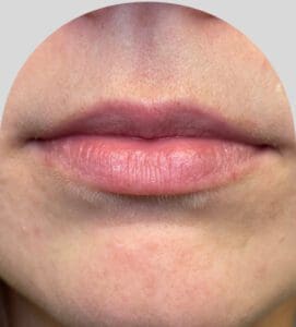 Lip Fillers - Case 26547 - Before