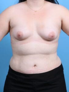 Breast Augmentation - Case 26604 - Before