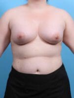 Breast Augmentation - Case 26604 - After
