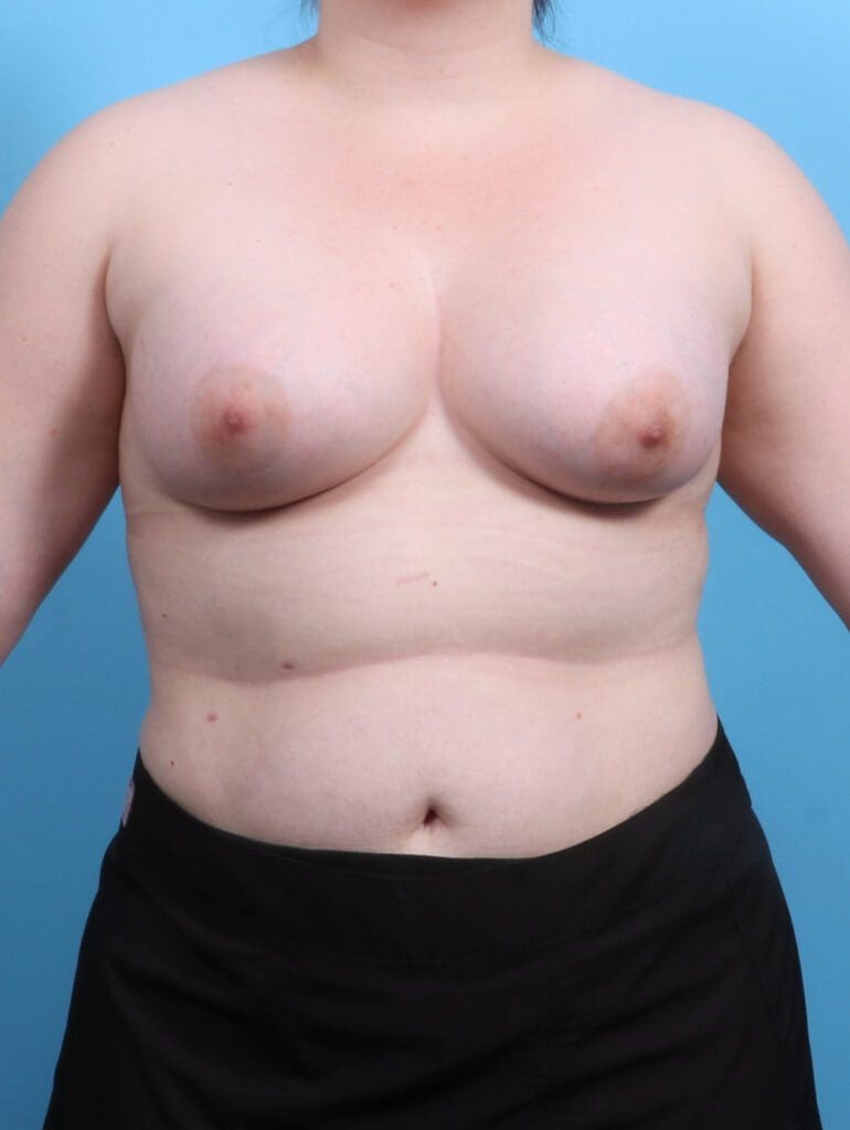 Breast Augmentation - Case 26604 - After