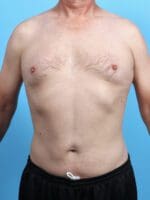 Male Liposuction - Case 26626 - After