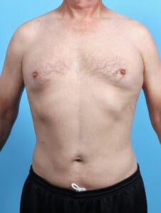 Male Liposuction - Case 26626 - After