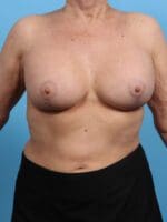Breast Implant Revision - Case 26683 - After