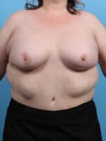 Breast Augmentation - Case 26725 - After
