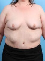 Breast Augmentation - Case 26725 - Before