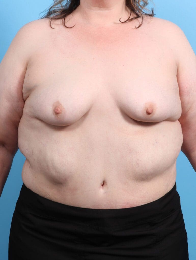 Breast Augmentation - Case 26725 - Before
