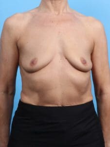 Breast Augmentation - Case 26798 - Before