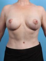 Breast Lift/Reduction w/o Implants - Case 26806 - After
