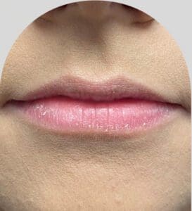 Lip Fillers - Case 26898 - Before