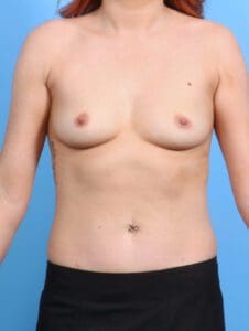 Breast Augmentation - Case 26912 - Before