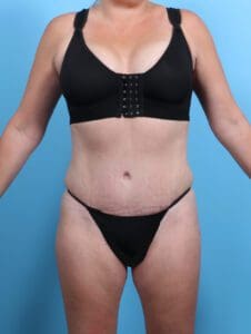 Tummy Tuck - Case 26946 - After