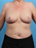 Breast Lift/Reduction w/o Implants - Case 27025 - After