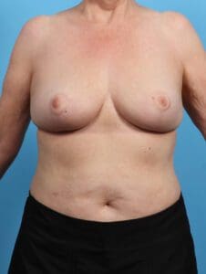 Breast Lift/Reduction w/o Implants - Case 27025 - After