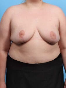 Breast Lift/Reduction w/o Implants - Case 27042 - After