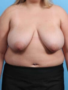 Breast Lift/Reduction w/o Implants - Case 27042 - Before