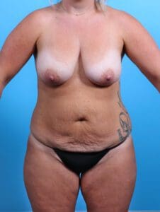 Breast Lift/Reduction with Implants - Case 27050 - Before