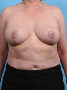 Breast Lift/Reduction w/o Implants - Case 27250 - After