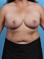 Breast Implant Revision - Case 27282 - After