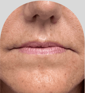 Lip Fillers - Case 27340 - Before