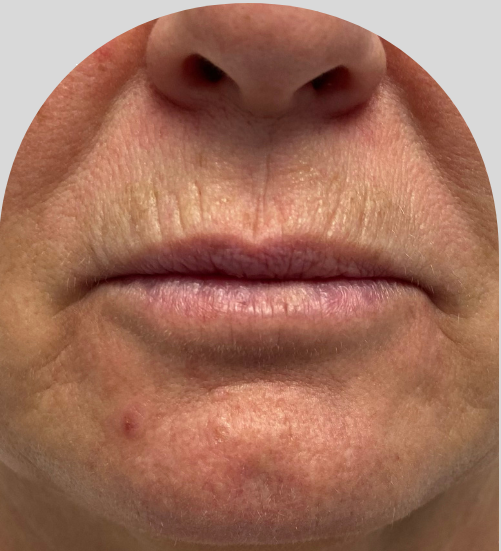 Lip Fillers - Case 27344 - Before