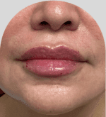 Lip Fillers - Case 27348 - After