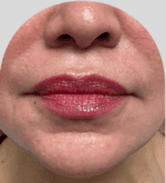 Lip Fillers - Case 27348 - Before