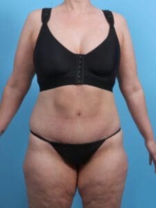 After Weight Loss - Case 27353 - After