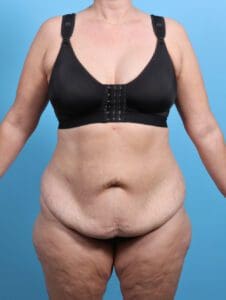 After Weight Loss - Case 27353 - Before
