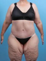After Weight Loss - Case 27399 - After