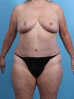 Breast Lift/Reduction w/o Implants - Case 27480 - After